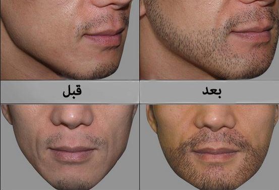 زراعة شعر الوجه في إيران