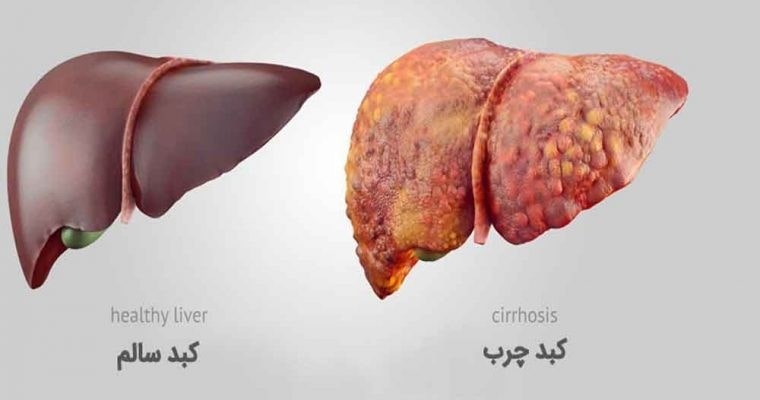 علاج مرض الكبد الدهني في إيران 