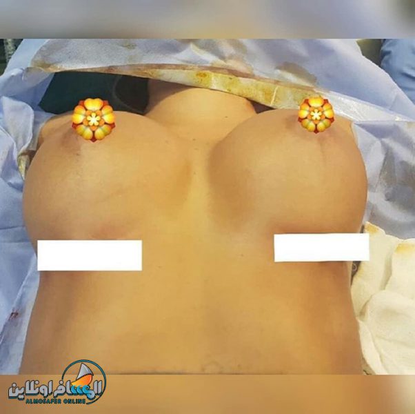 عمليات تجميل الثدي في إيران