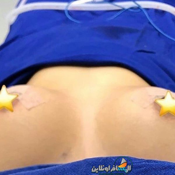عمليات تجميل الثدي في إيران