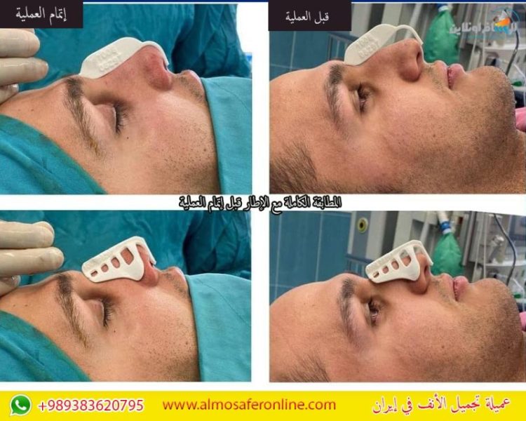 عميلة تجميل الأنف في إيران