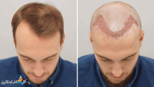 زراعة الشعر في مشهد
