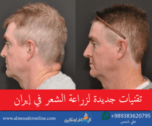 تقنيات جديدة لزراعة الشعر في إيران