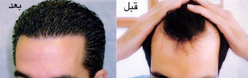 زراعة الشعر في إيران