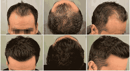 زراعة الشعر في إيران