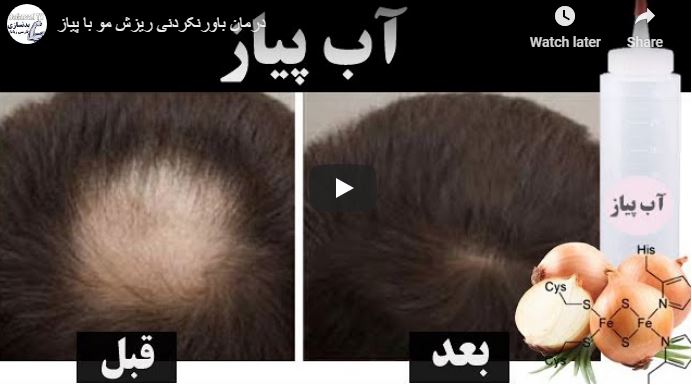 علاج لا يصدق لتساقط الشعر مع البصل
