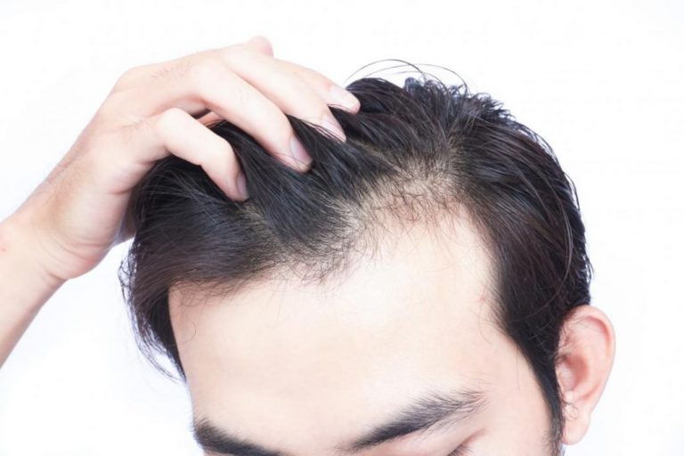 مخاطر زرع الشعر الرخيص في إيران