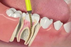 علاج الجذور وأعصاب الأسنان في إيران