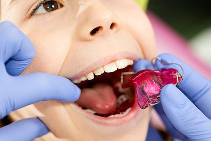 كيف يتم تقويم الأسنان للأطفال