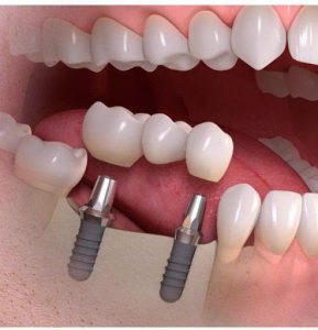 زرع الأسنان بدون جراحة اللثة في إيران