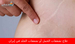 علاج تشققات الحمل أو تشققات الجلد في إيران