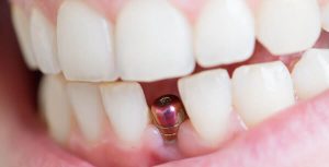 علاج وجع الاسنان بعد زرع الأسنان في إيران