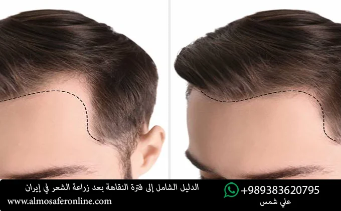 الدليل الشامل إلى فترة النقاهة بعد زراعة الشعر في إيران