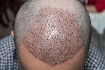 تقنية Micro Graft لزراعة الشعر