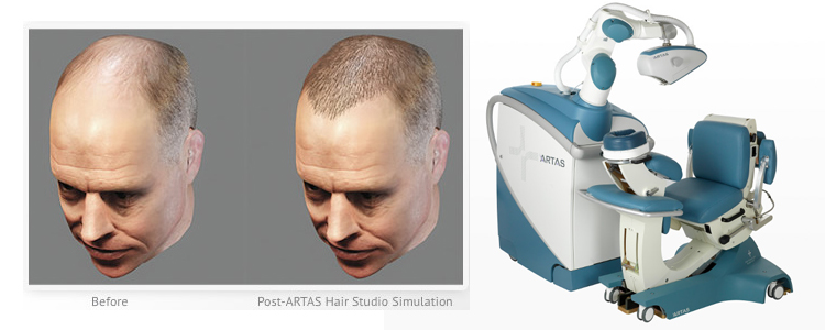 تقنية آرتاس لزراعة الشعر
