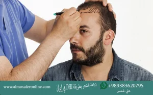 زراعة الشعر بطريقة DHI في إيران