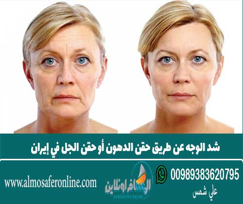شد الوجه عن طريق حقن الدهون أو حقن الجل في إيران