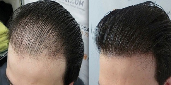 زراعة الشعر بدون حلاقة في إيران بتقنية DHI و FIT