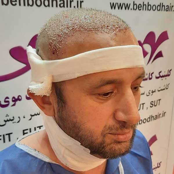 زراعة الشعر من اللحية الى الرأس في إيران