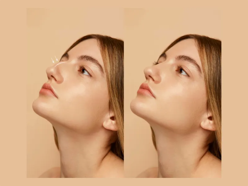 عمليات تجميل الأنف