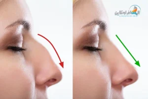 عمليات التجميل في إيران