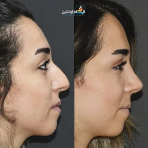 تجميل الأنف في إيران