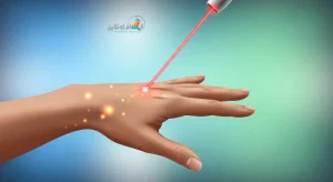 العلاج بالليزر في إيران