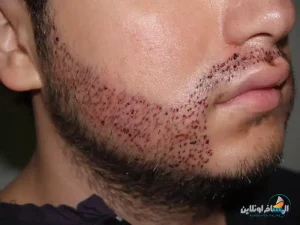 زراعة اللحية في إيران