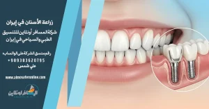 زراعة الأسنان في إيران