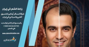 زراعة الشعر في إيران