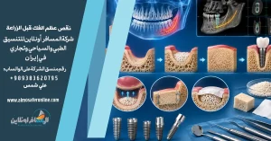 نقص عظم الفك قبل الزراعة