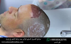 مبادئ الغسيل السليم للرأس بعد زراعة الشعر في إيران محافظات طهران وشيراز