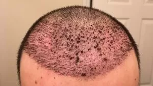 احمرار الرأس بعد زراعة الشعر في إيران